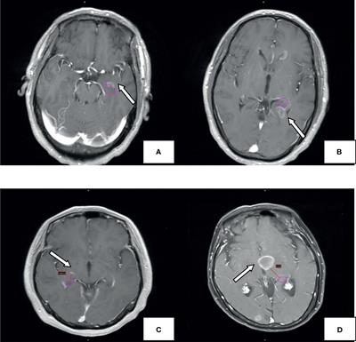 The Risk of Hippocampal Metastasis and the Associated High-Risk Factors in 411 Patients With Brain Metastases